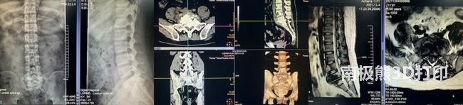 3D printing technology can help patients in spinal surgery and give them a new life