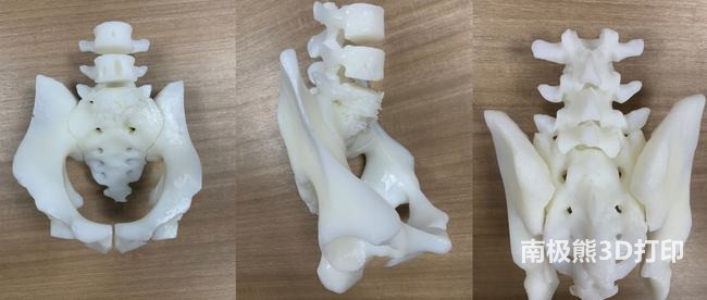 3D printing technology can help patients in spinal surgery and give them a new life