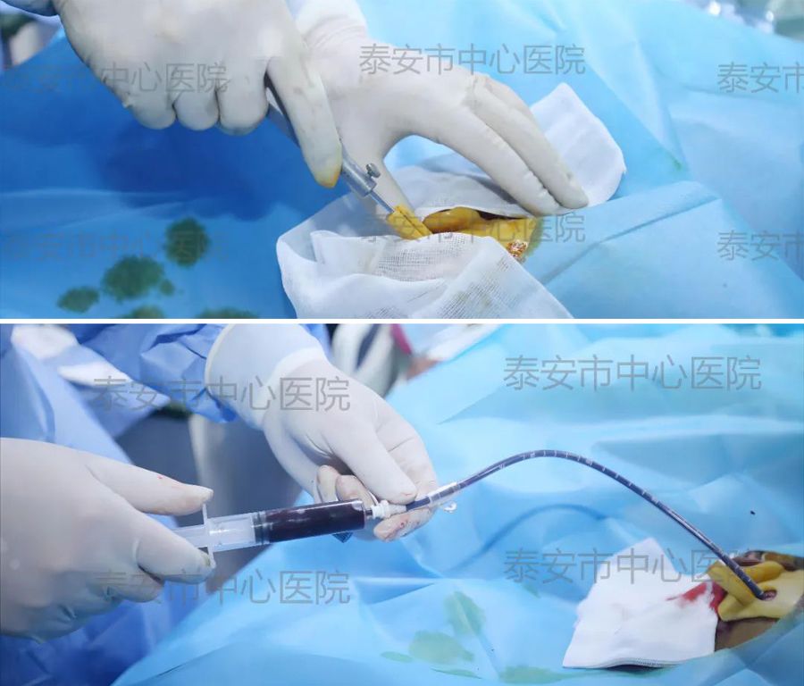 Shandong Tai 'an 3D printing technology adds a new means for puncture treatment of patients with bra